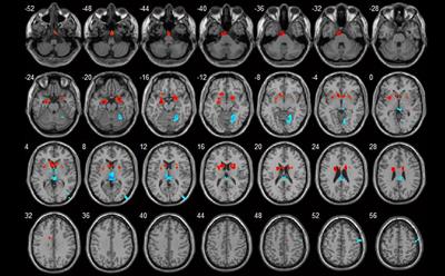 A Conscious Resting State fMRI Study in SLE Patients Without Major Neuropsychiatric Manifestations